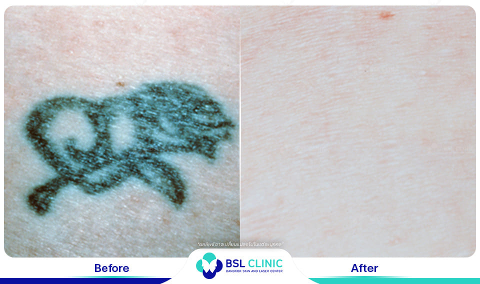 results tattoo removal