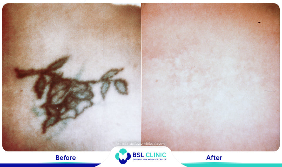 results tattoo removal