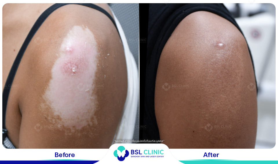 result before after scar