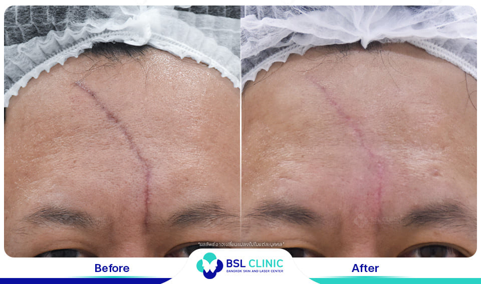 result before after scar