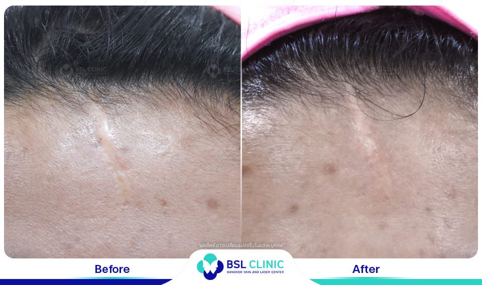 result before after scar