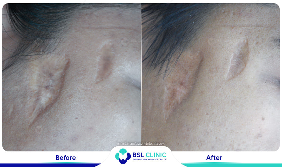 result before after scar