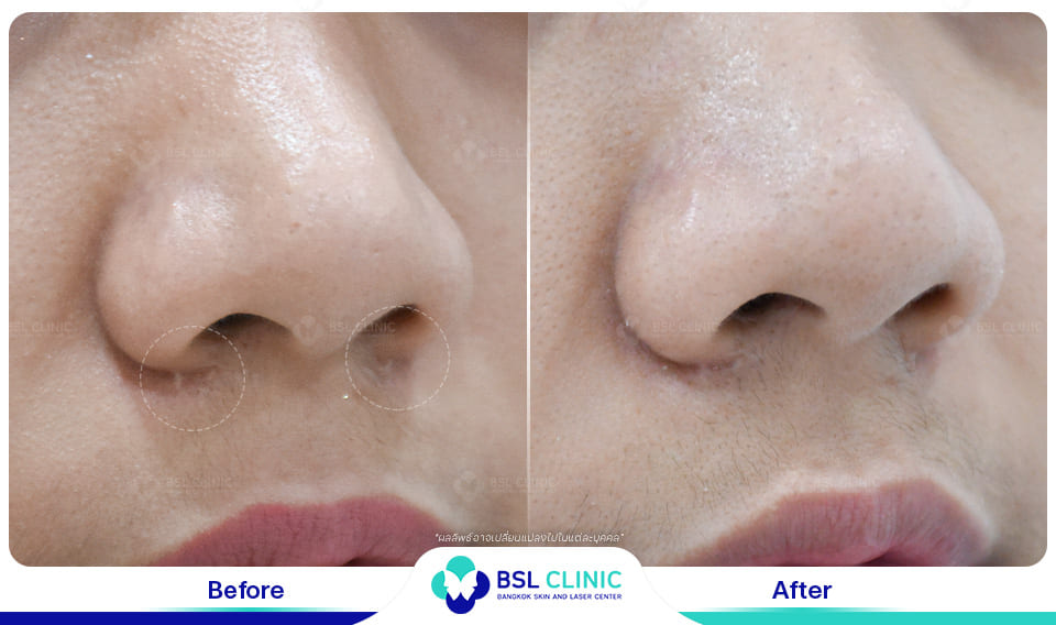 result before after scar