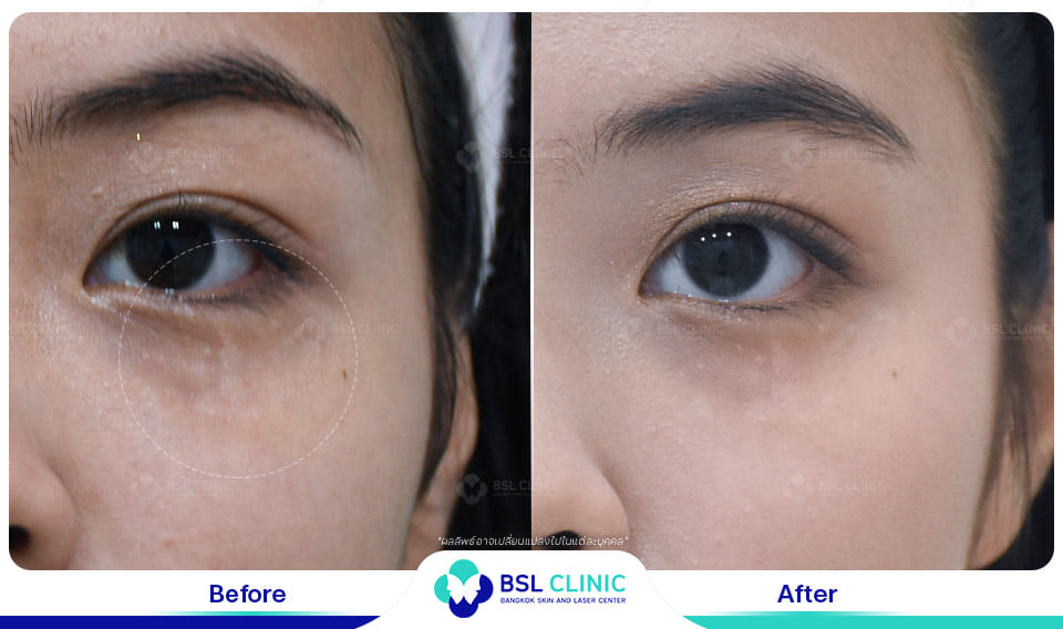 result before after scar