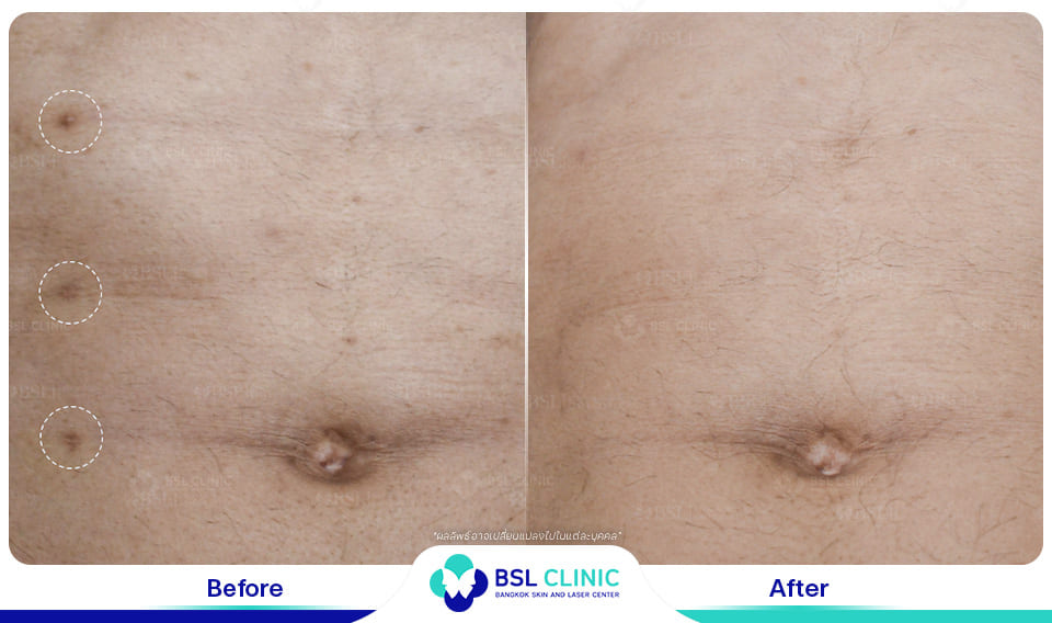 result before after scar