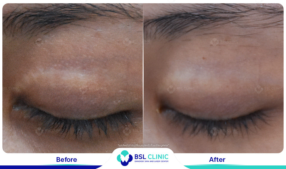 result before after scar