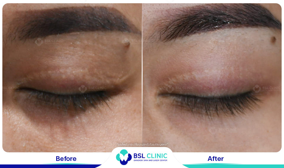 result before after scar