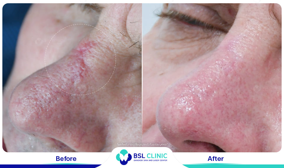 result before after scar