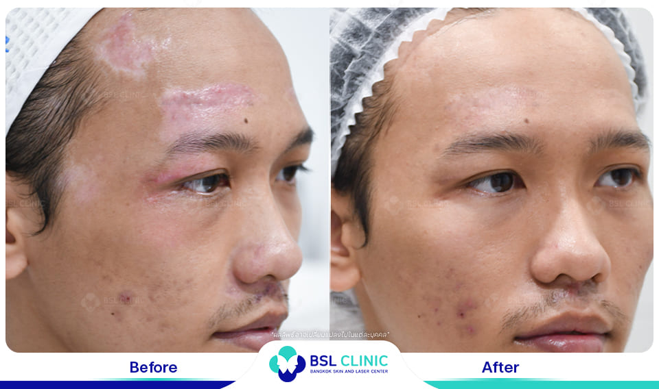 result before after scar