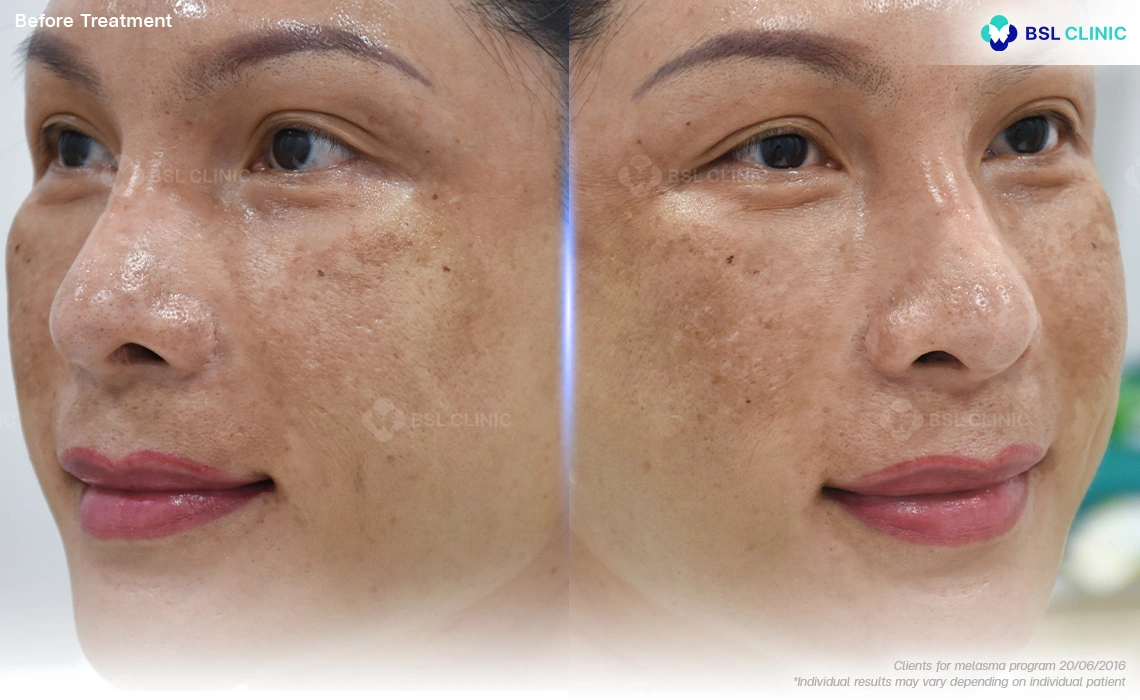 before melasma treatment