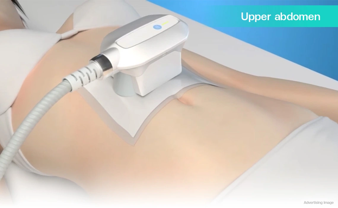 coolshaping2 applicator applied to upper abdomen to target stubborn fat cells non surgically