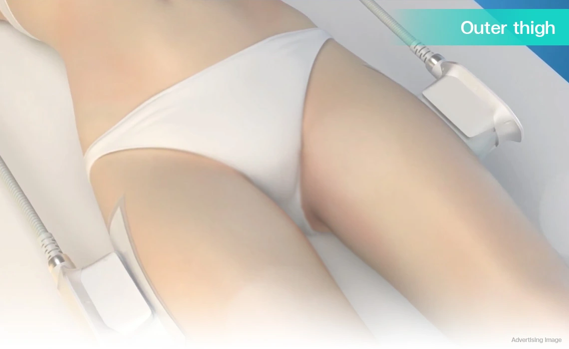 coolshaping2 applicators on outer thigh fat freezing for saddlebag contouring