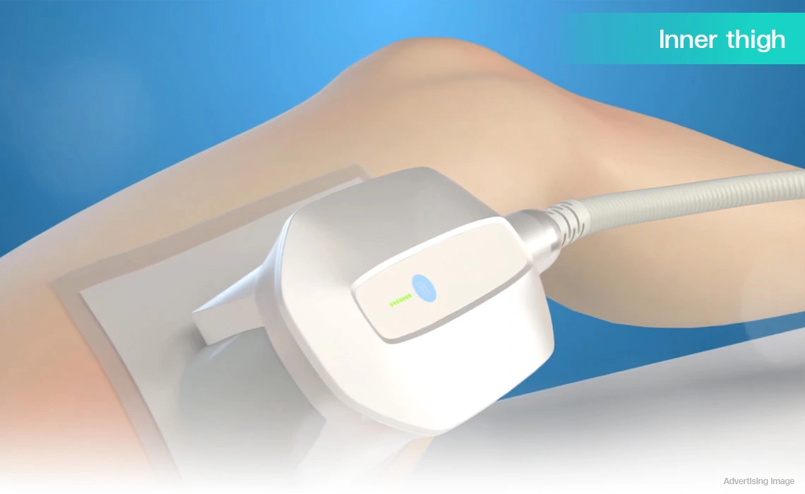 coolshaping2 fat reduction treatment on inner thigh to improve leg contour