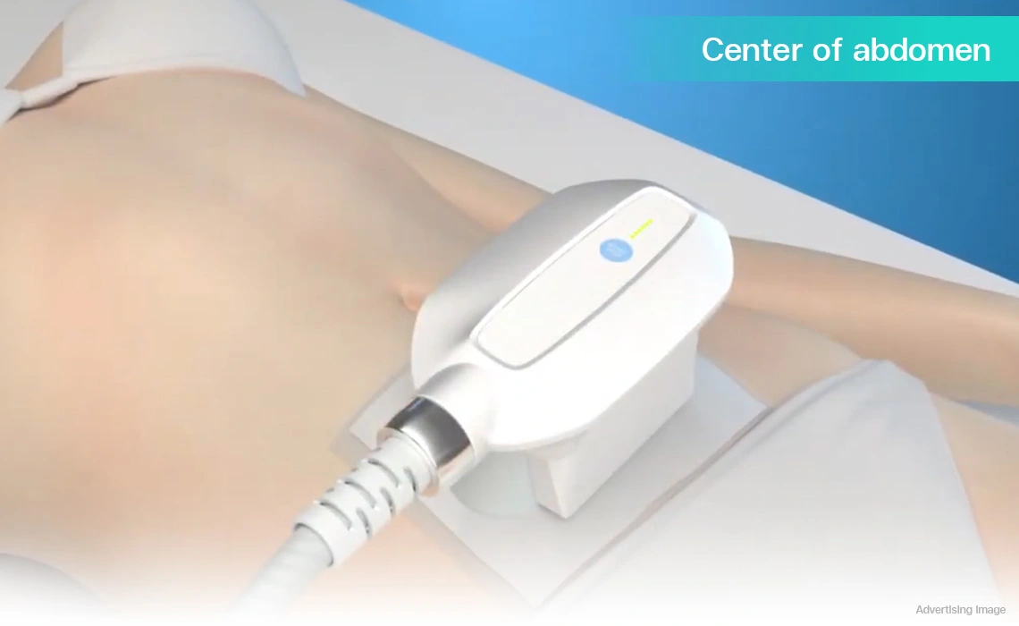 coolshaping2 program applicator on center of abdomen during cryolipolysis fat reduction treatment
