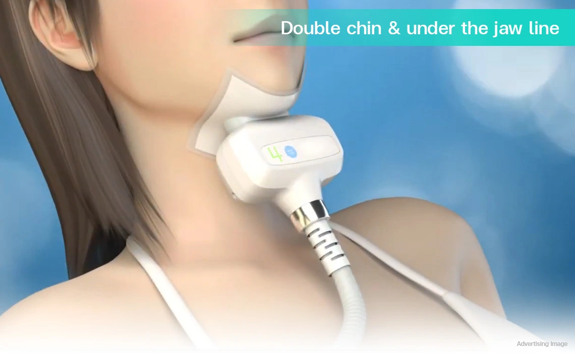 coolshaping2 submental applicator on double chin for jawline refinement non invasive fat reduction