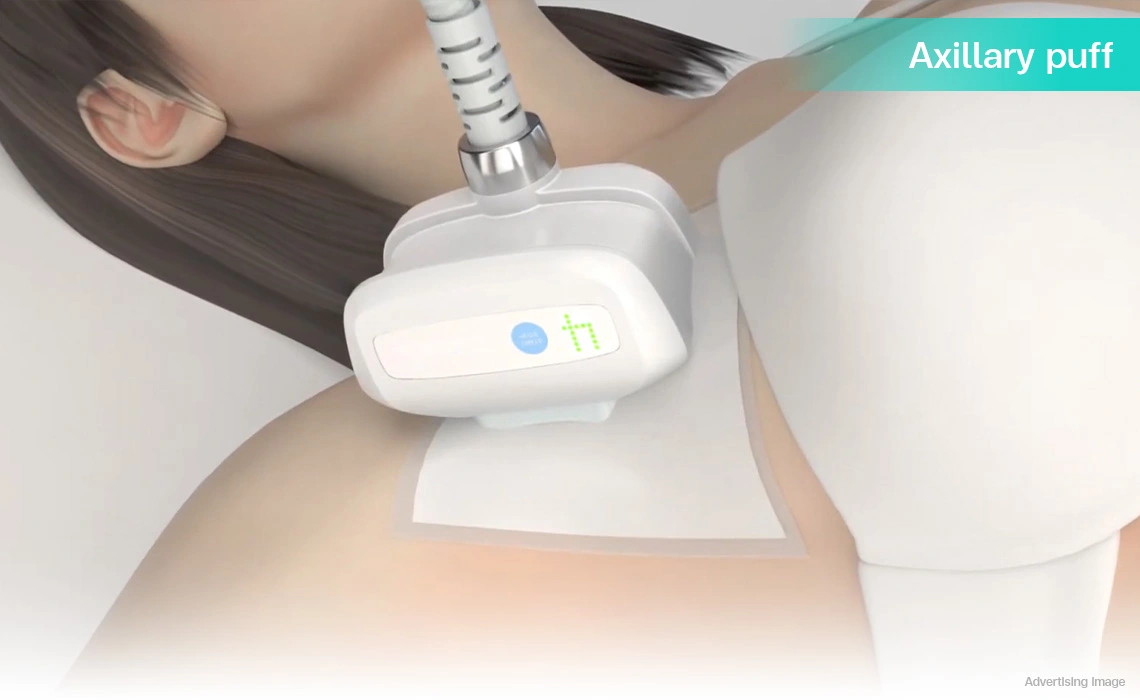 coolshaping2 underarm fat reduction axillary puff treatment for bra bulge removal
