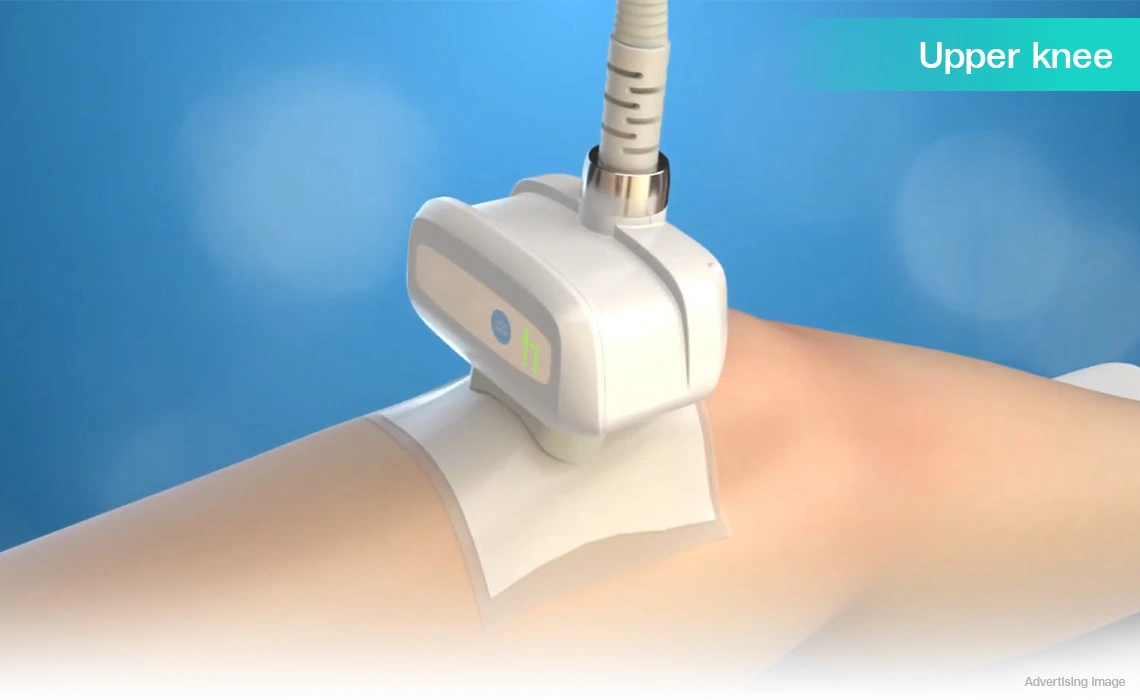 coolshaping2 upper knee fat freezing treatment for leg contouring knee fat reduction non surgical