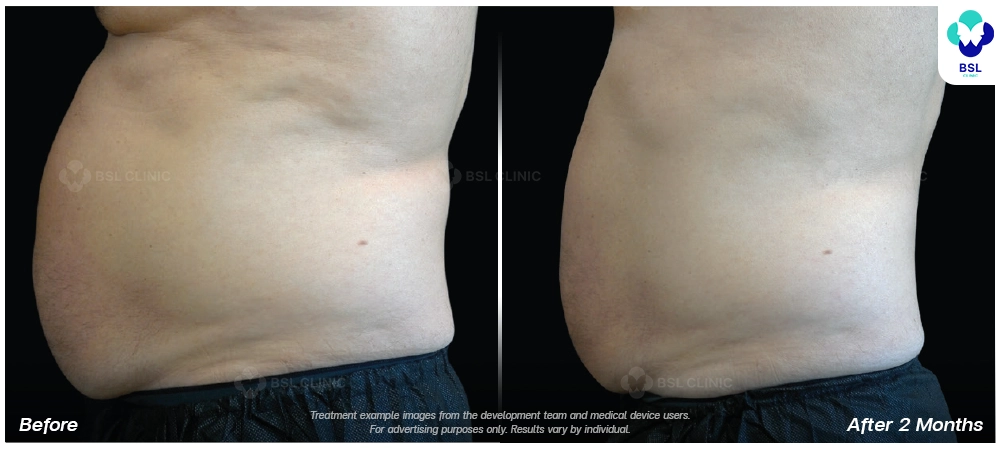 Emsculpt neo before and after