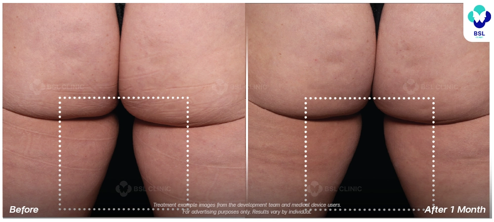 Emsculpt neo before and after