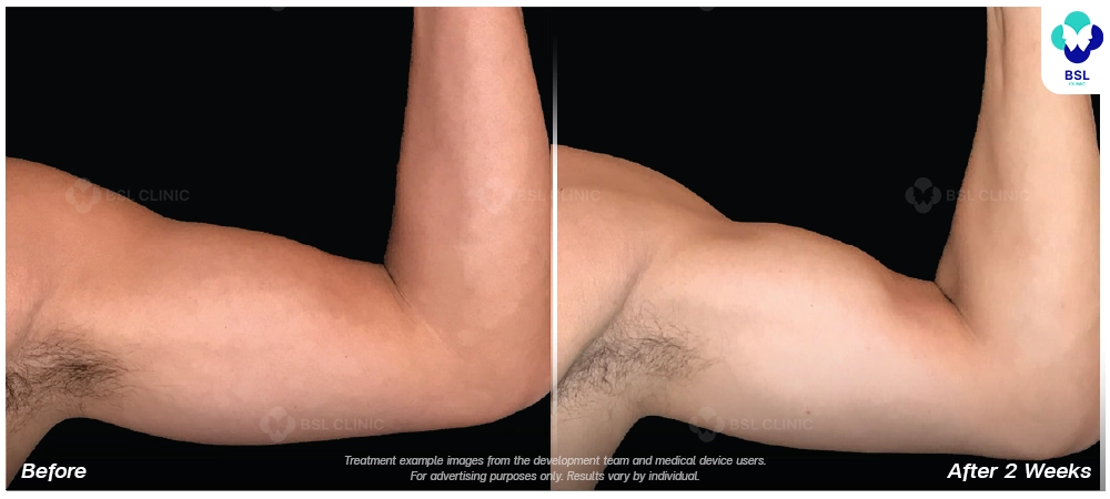 Emsculpt neo before and after