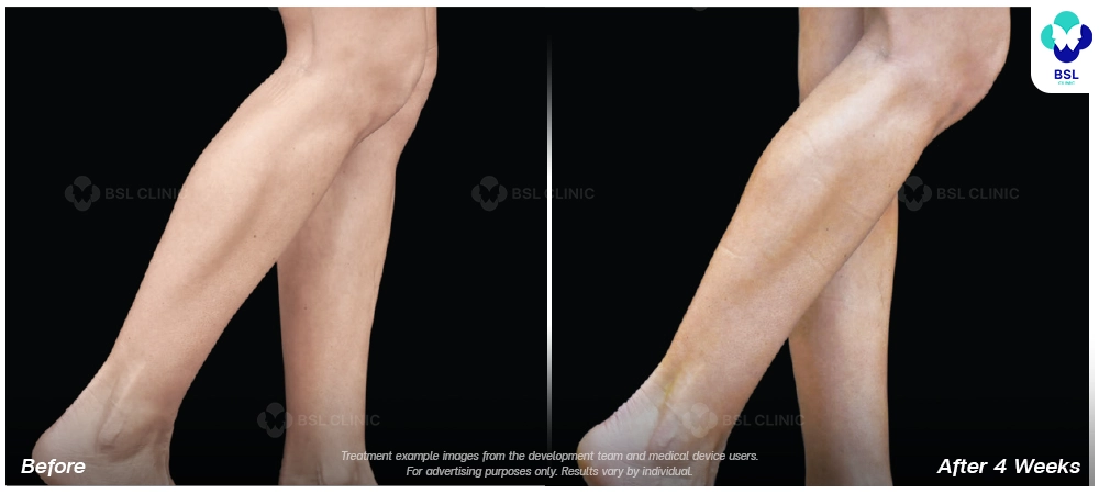 Emsculpt neo before and after