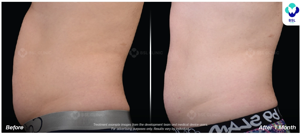 Emsculpt neo before and after