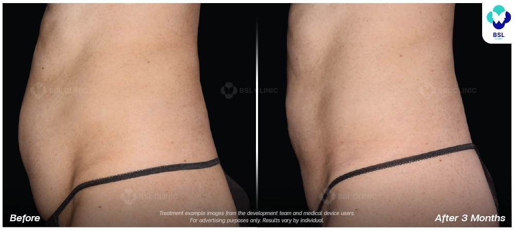 Emsculpt neo before and after