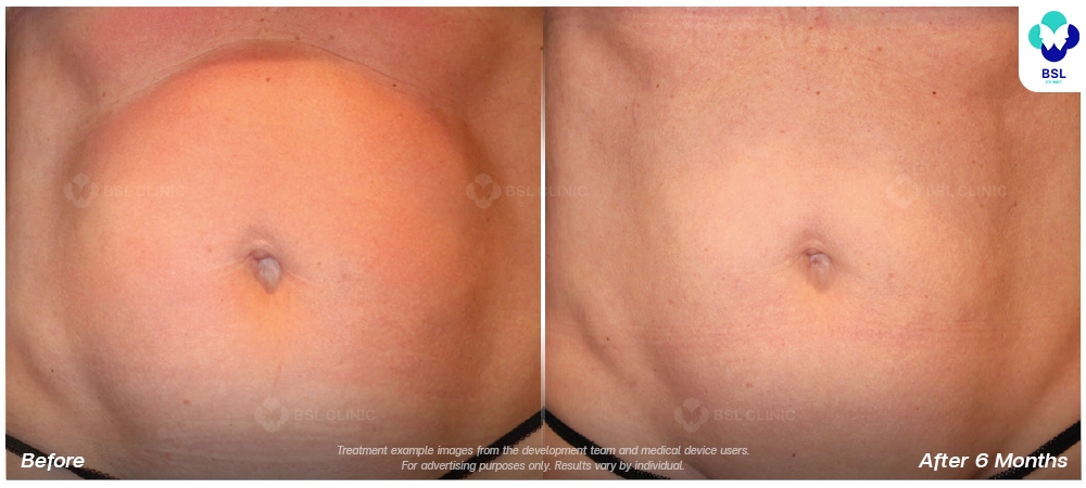 Emsculpt neo before and after