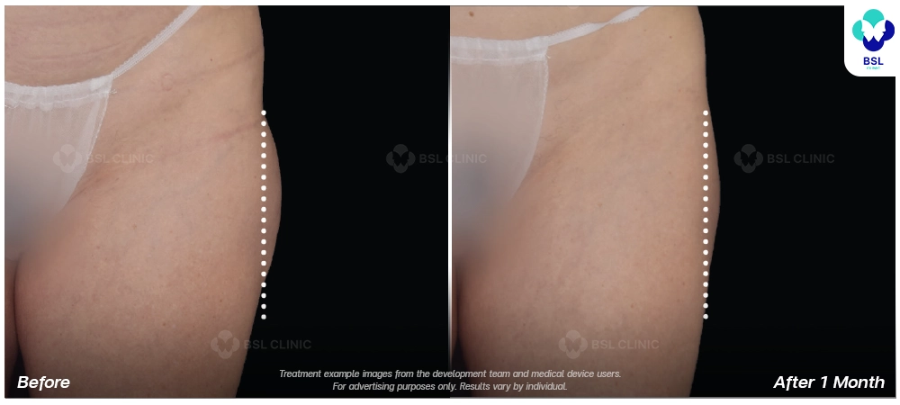 Emsculpt neo before and after