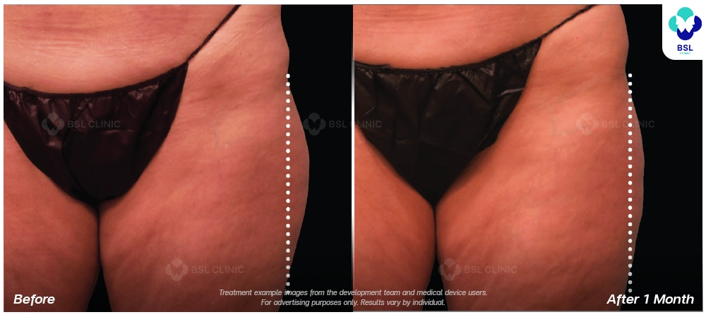 Emsculpt neo before and after