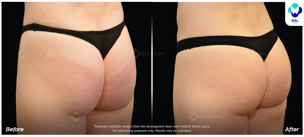Emsculpt neo before and after