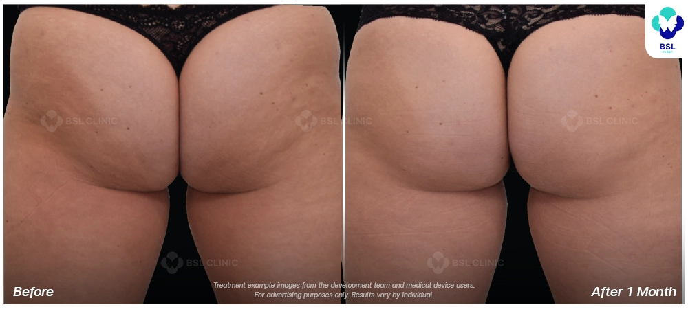 Emsculpt neo before and after