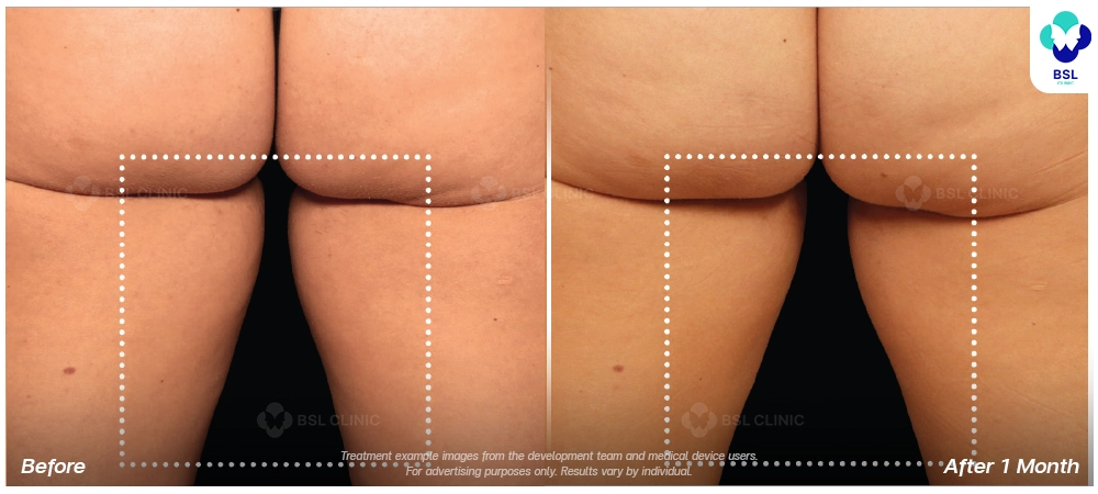 Emsculpt neo before and after