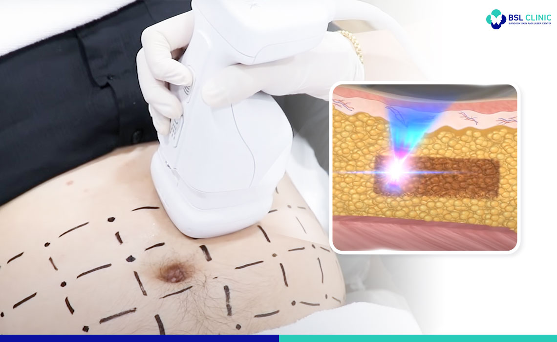 fat tissues Liposonix treatment