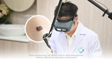 Skin tag