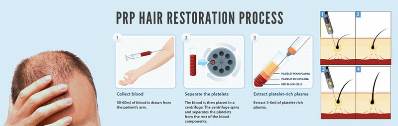 Hair Restoration Injection Therapy