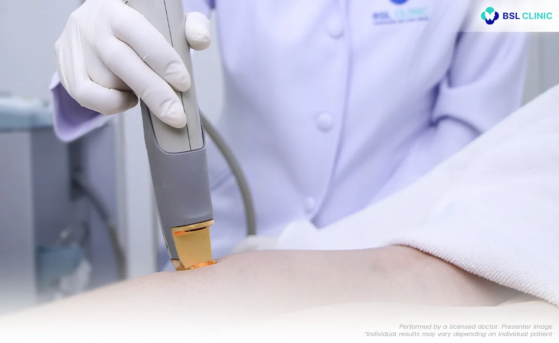 leg veins spider veins Vascular Laser