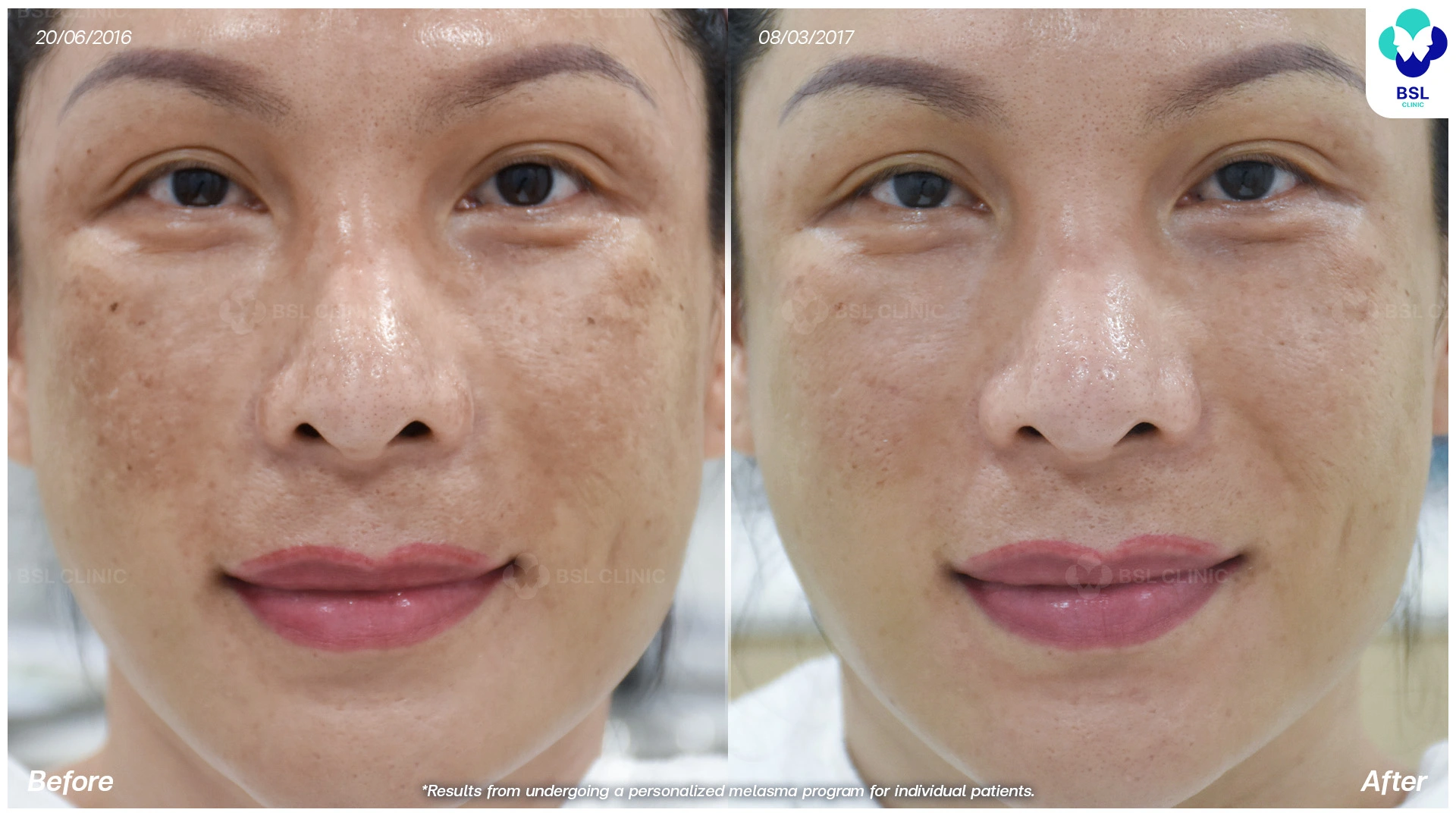 before after melasma treatment