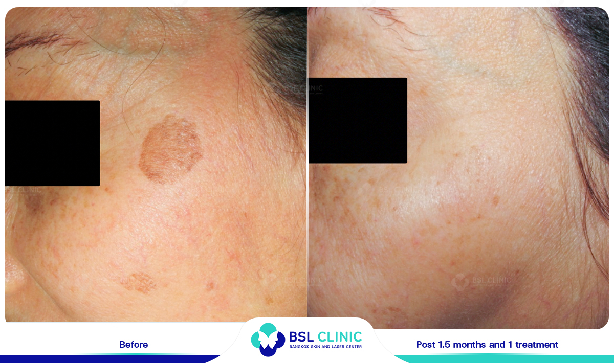 picoway Melasma, Mask of pregnancy, Freckles, Dark spot