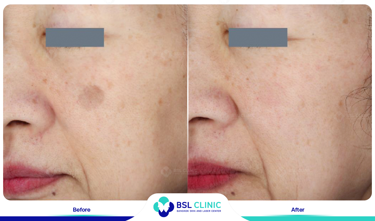 picoway Melasma, Mask of pregnancy, Freckles, Dark spot