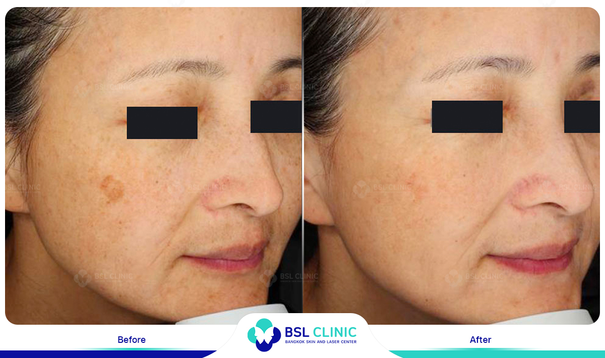 picoway Melasma, Mask of pregnancy, Freckles, Dark spot