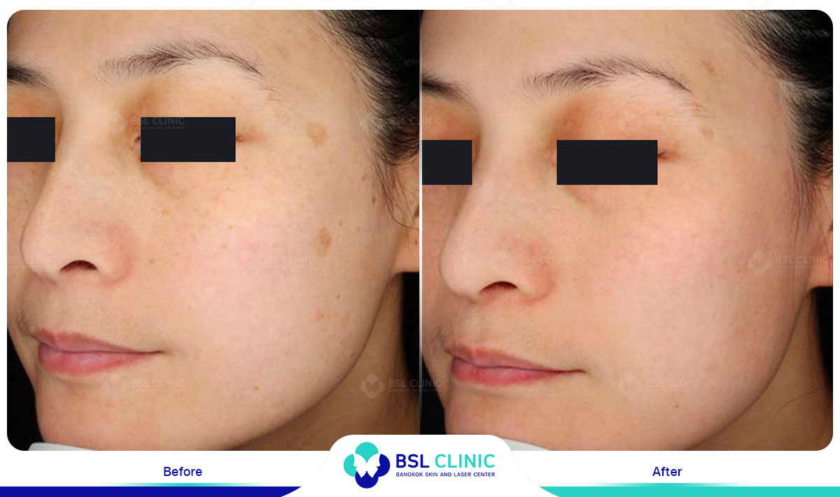 picoway Melasma, Mask of pregnancy, Freckles, Dark spot