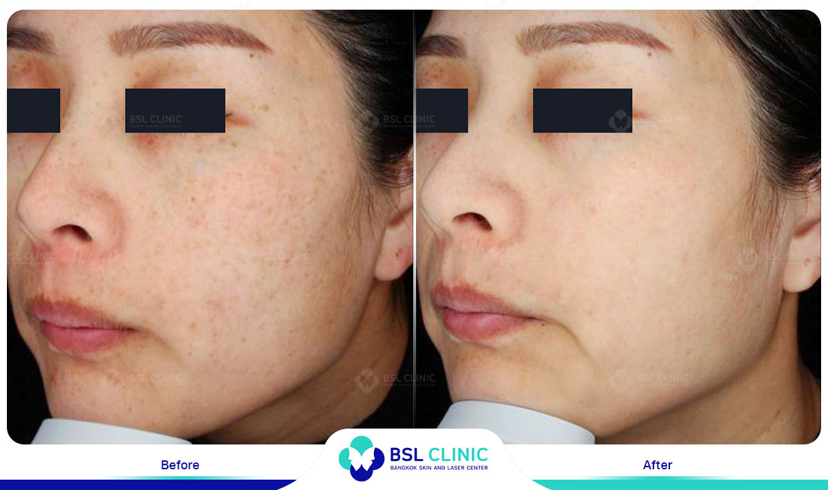 picoway Melasma, Mask of pregnancy, Freckles, Dark spot