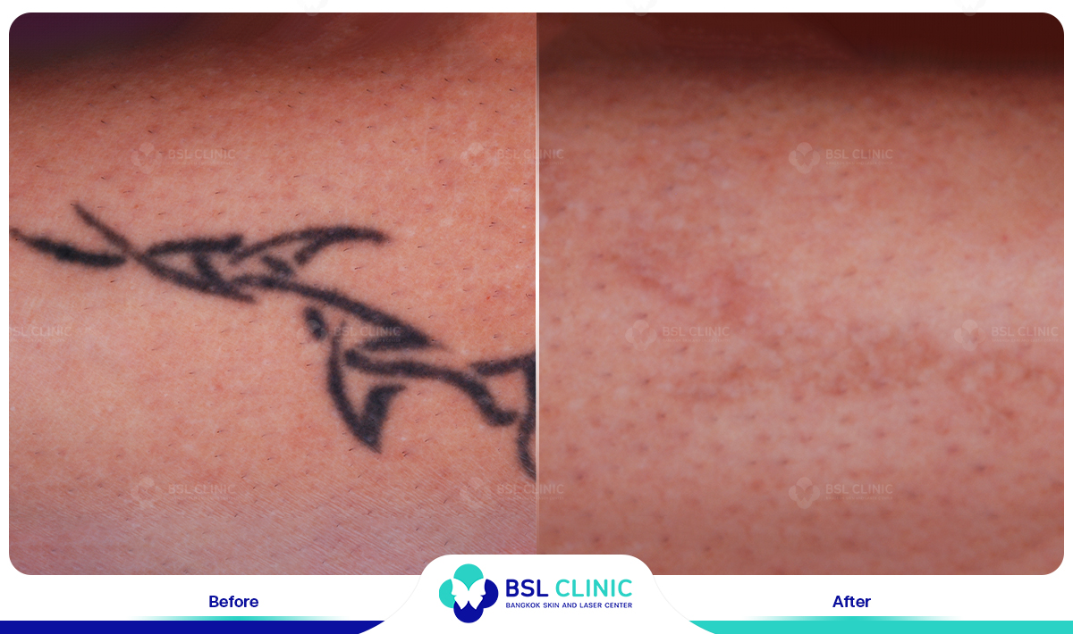 results tattoo removal