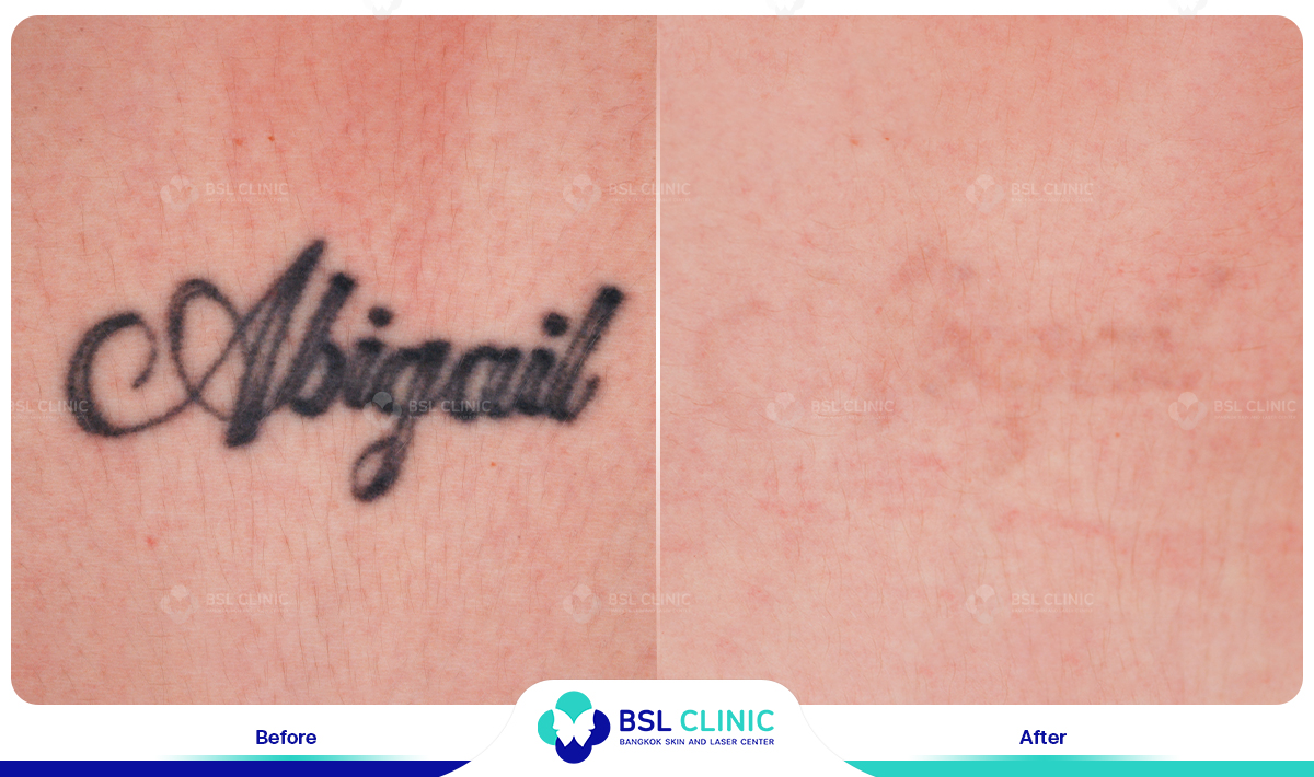 results tattoo removal
