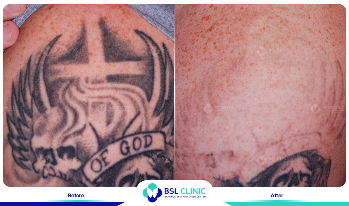 results tattoo removal