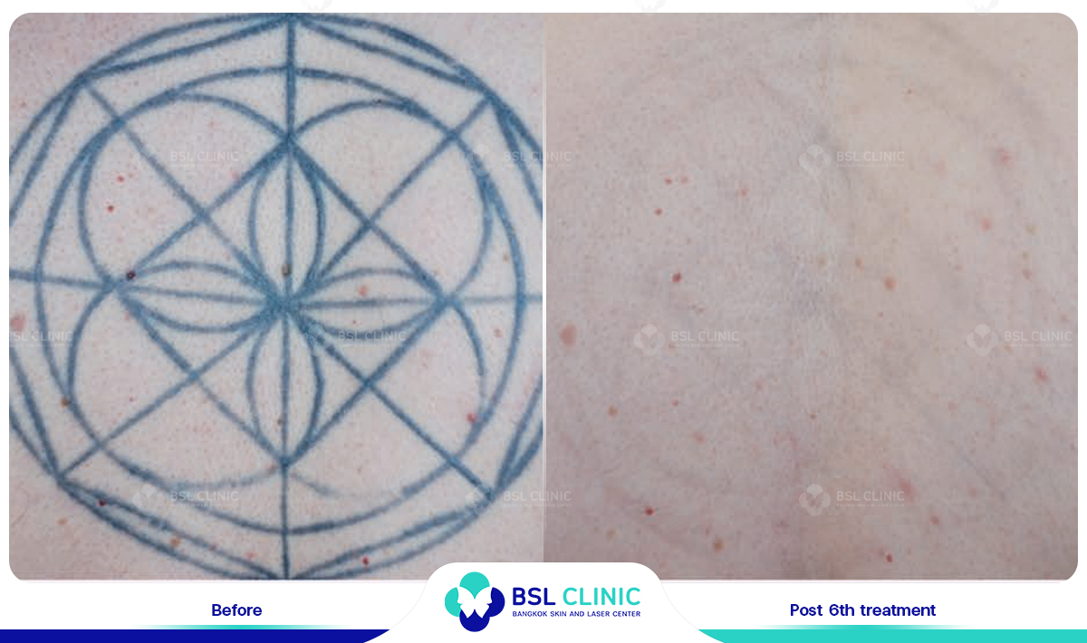 results tattoo removal