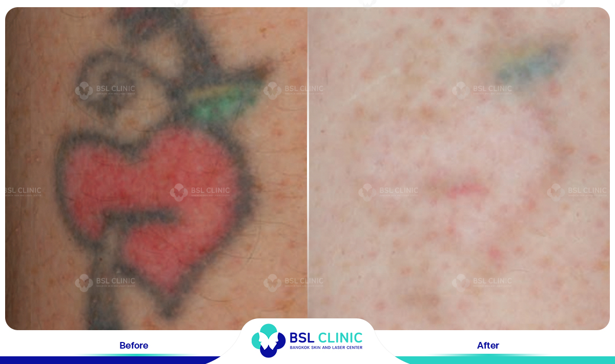 results tattoo removal