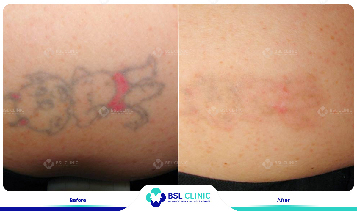 results tattoo removal