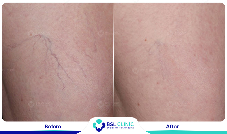 result Facial Redness (Rosacea) Red Birthmarks Spider and Leg Veins